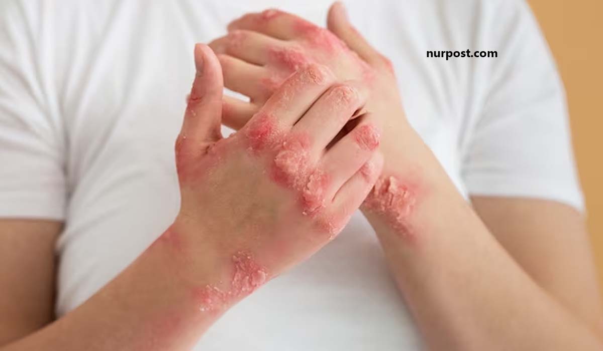 Signs and symptoms of psoriasis
