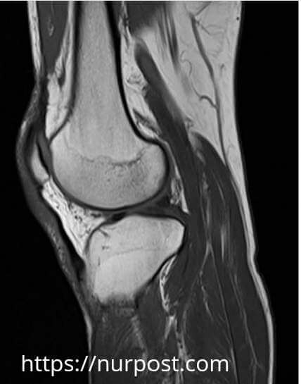 MRI report of Knee