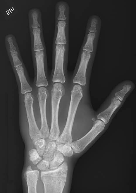 X-ray report of hand